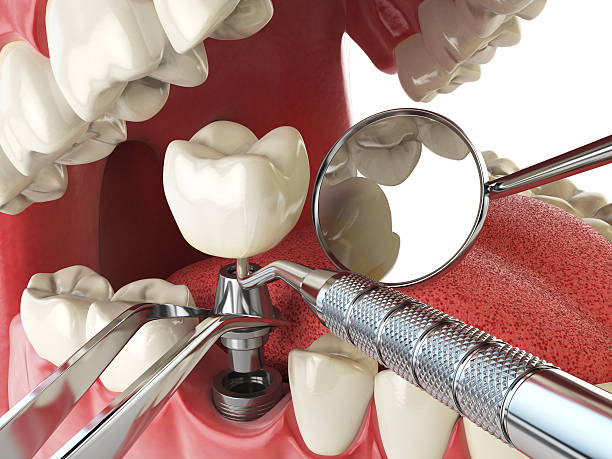 Best Cracked Tooth Emergency Dentist  in Lehigh Acres, FL